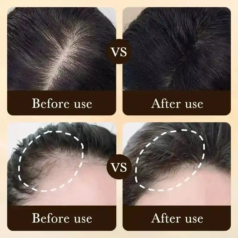 Biotin Hair Growth Oil Scalp Massage Kit - 10pcs Tidesmit Massage Cushion Tidesmit