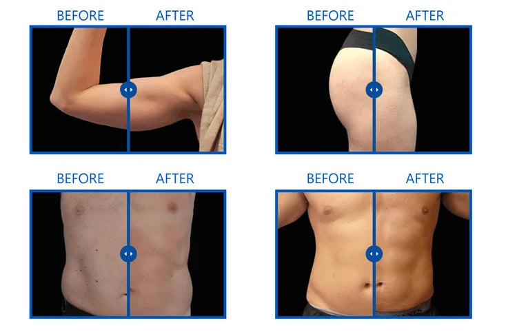 EMS Body Slimming Machine for Muscle Sculpting and Fat Reduction Relaxation Treatment Tidesmit