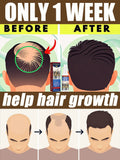Ginger Hair Growth Spray for Scalp Nourishment and Root Strength Relaxation Treatment Pack of 1Pcs Tidesmit