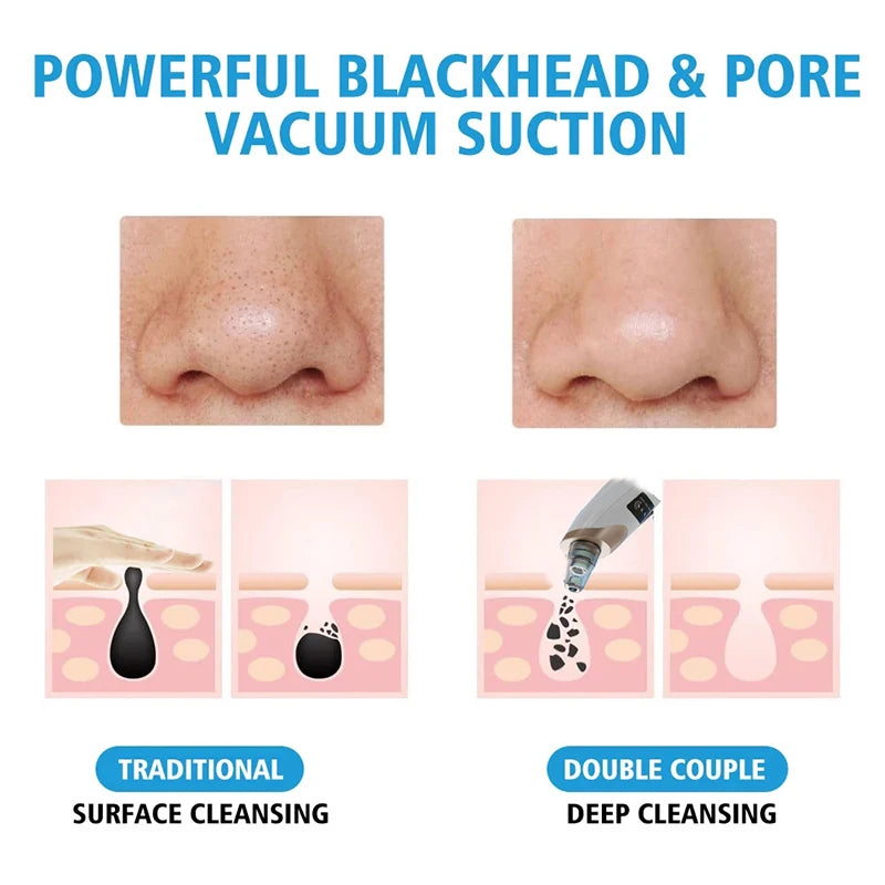 Comparison chart showing before and after blackhead removal using a portable electric pore vacuum suction device.
