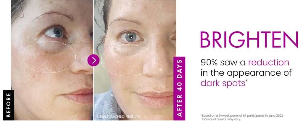 Before and after comparison of a woman’s face showing reduced dark spots after 40 days of using collagen face cream.