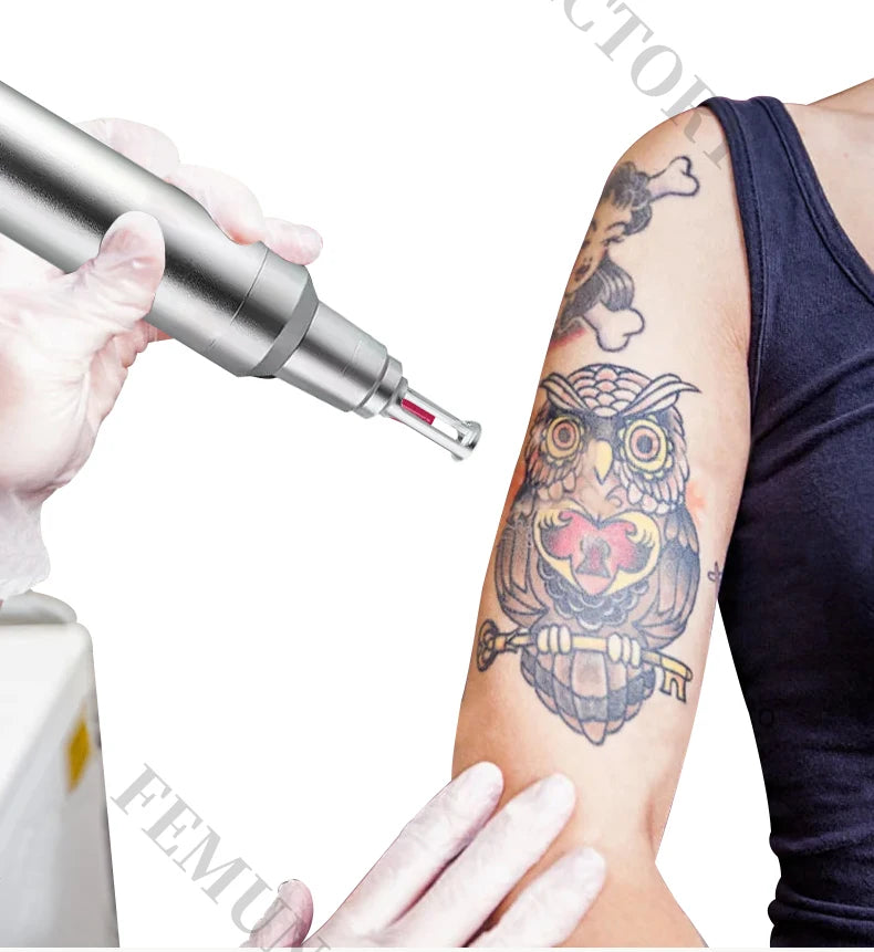 Portable 4000W Nd:YAG picosecond laser machine removing an arm tattoo with a silver handheld applicator device.