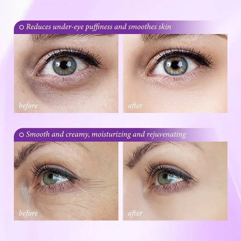 Before and after showing anti-wrinkle eye cream reducing puffiness, dark circles, and fine lines for smoother skin.