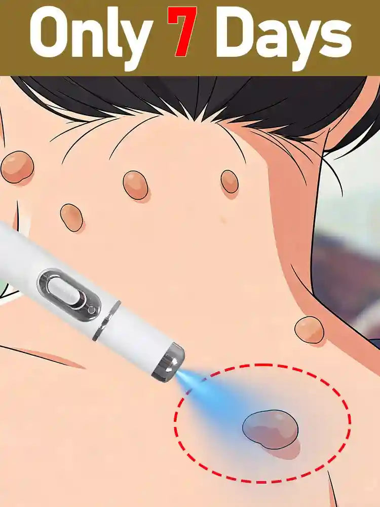Wart Removal Pen for Skin Tags - Precise Face and Body Treatment Massage Roller Tidesmit