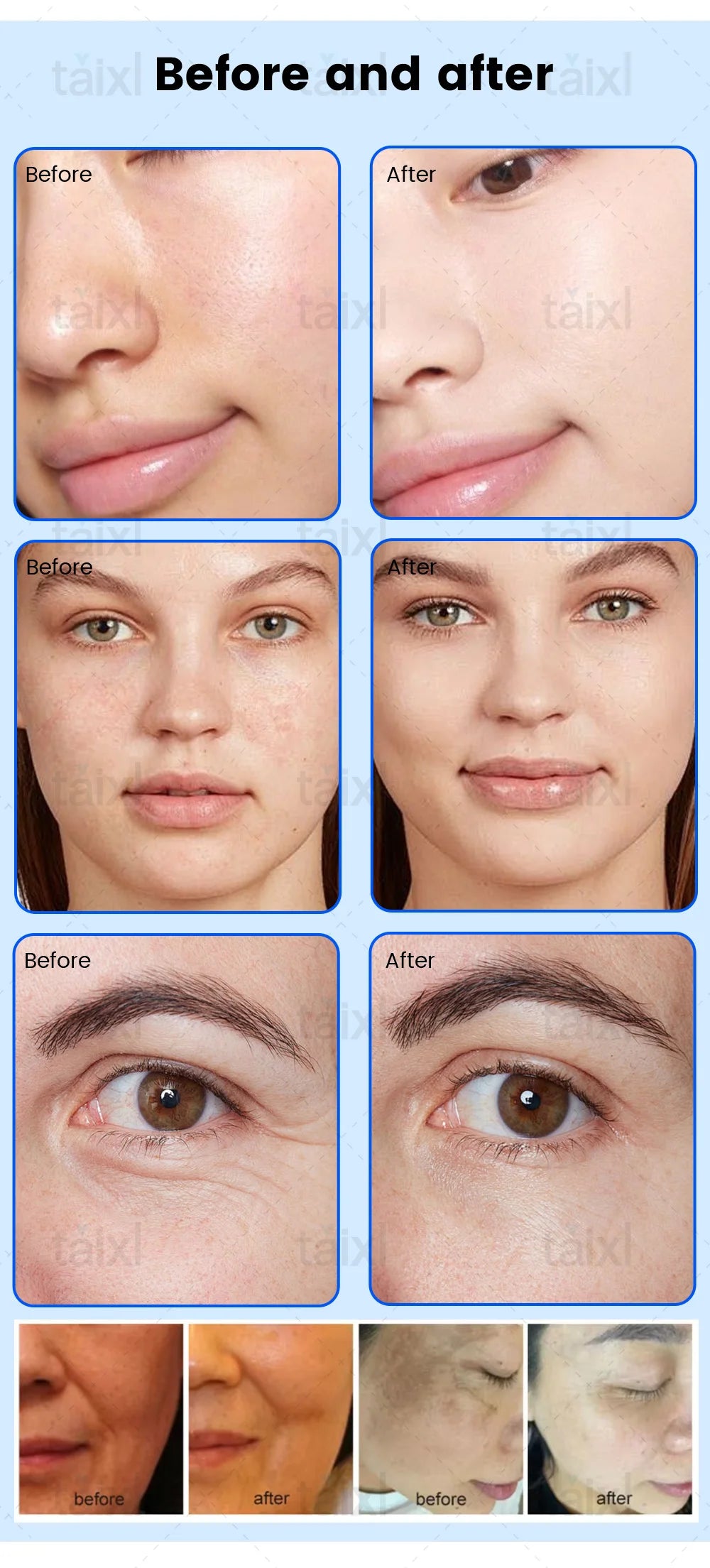 Before and after results of plasma facial treatment for skin rejuvenation, anti-aging, and blemish reduction.