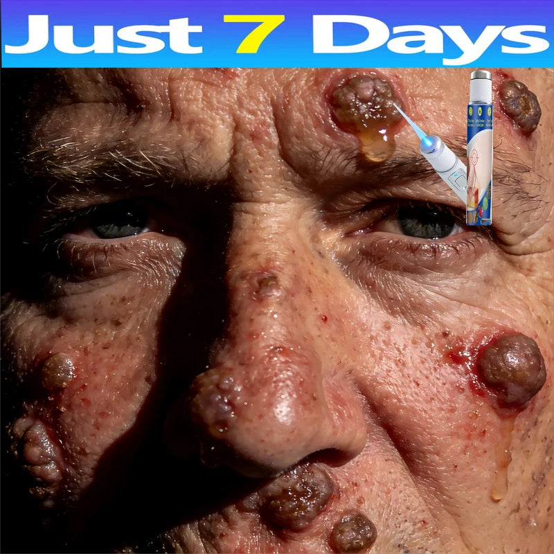 2026 blue laser wart removal pen handheld tool for home skin treatment, shown with light beam on a person's face.