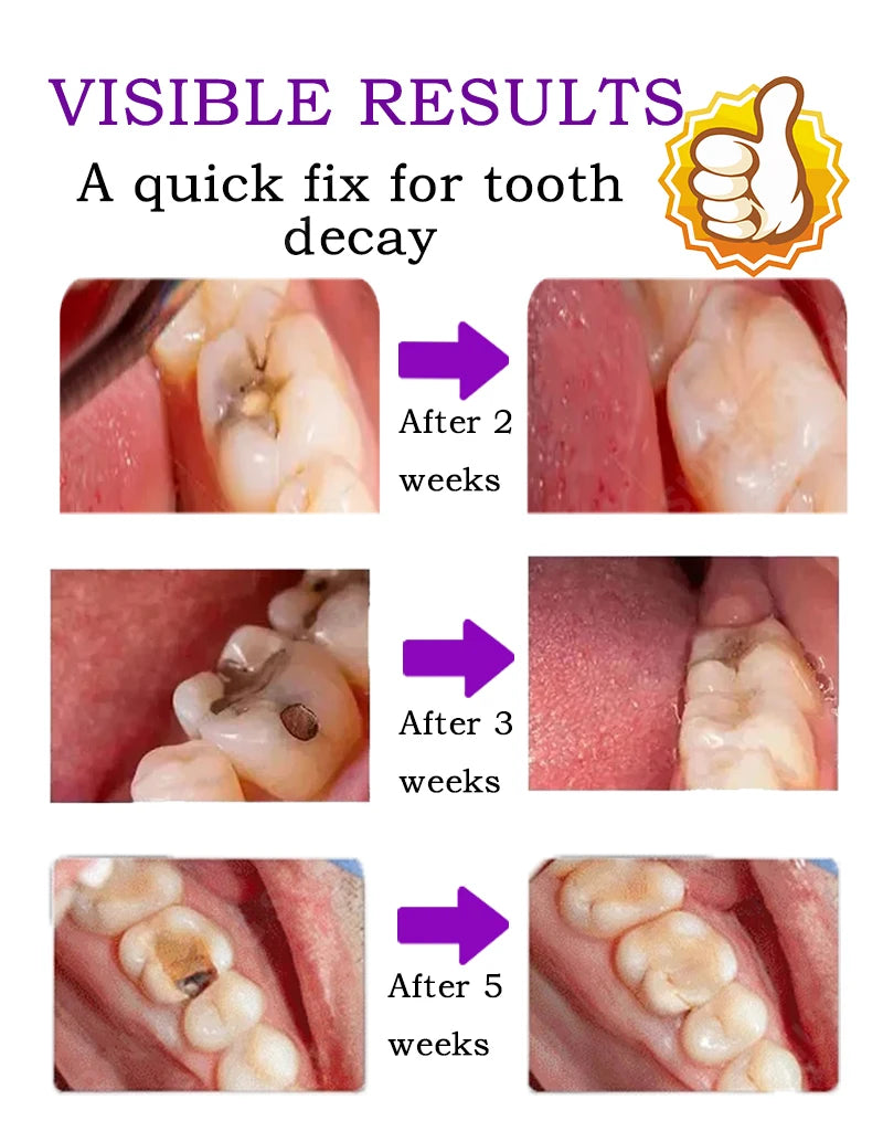 Tidesmit anti-caries teeth whitening treatment for healing cavities and repairing tooth decay