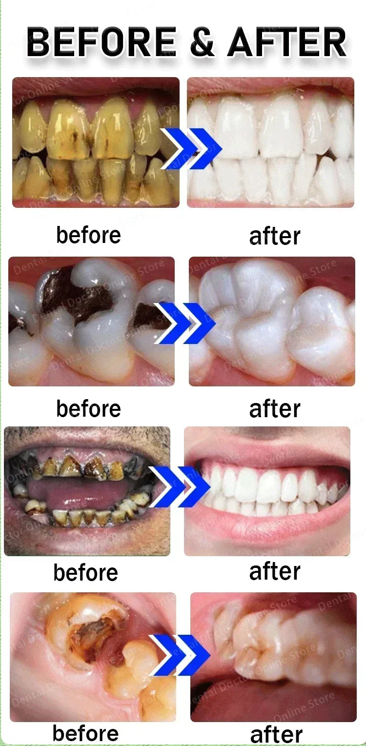 Tidesmit teeth whitening and cavity repair kit for plaque removal and dental health improvement