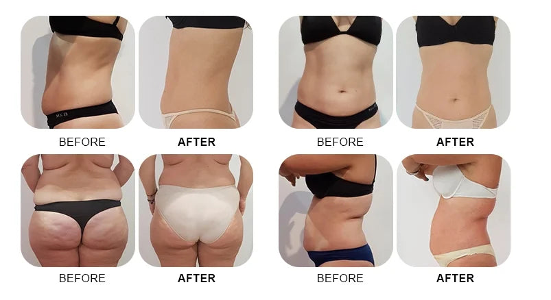 Body Slimming Machine for Cellulite Reduction and Skin Tightening Back Massage Instrument Tidesmit