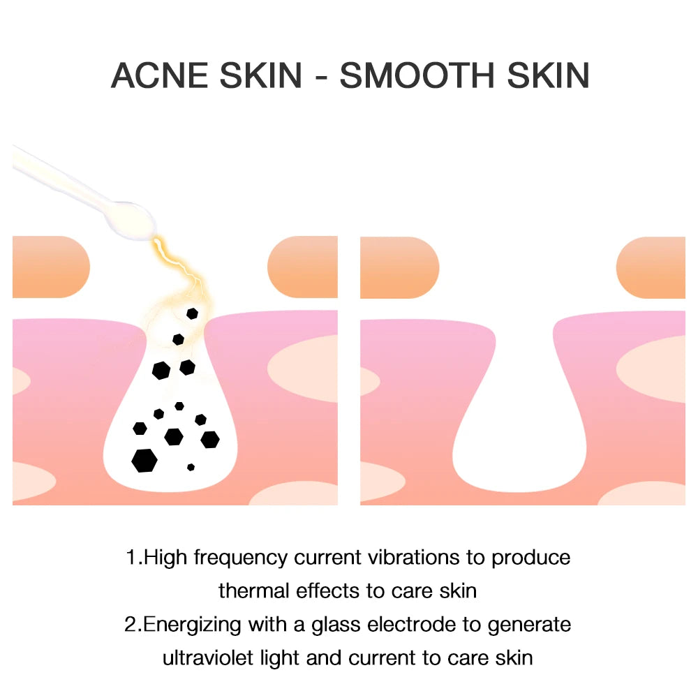 Diagram of high-frequency glass electrode wand treating acne, showing current clearing skin pores.