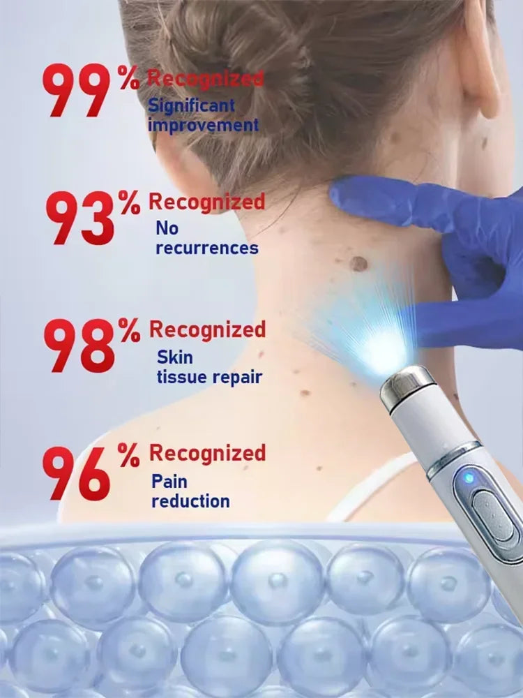 Blue Light Wart Removal Tool - Portable LED Skin Therapy Device Relaxation Treatment Tidesmit