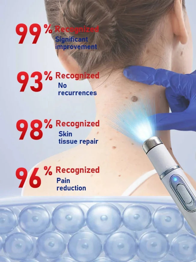 Blue Light Wart Removal Tool - Portable LED Skin Therapy Device Relaxation Treatment Tidesmit