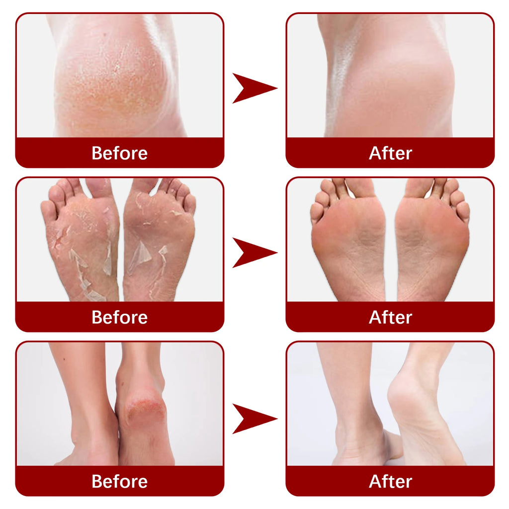 Exfoliating Foot Peel Mask - Apple Extract Callus Remover (5-15 Pack) Scrubs Treatments Tidesmit