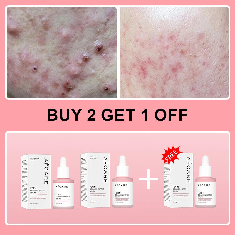 AFCARE collagen peptide facial serum set. Clear, pink-tinted dropper bottles with white boxes for skin repair.