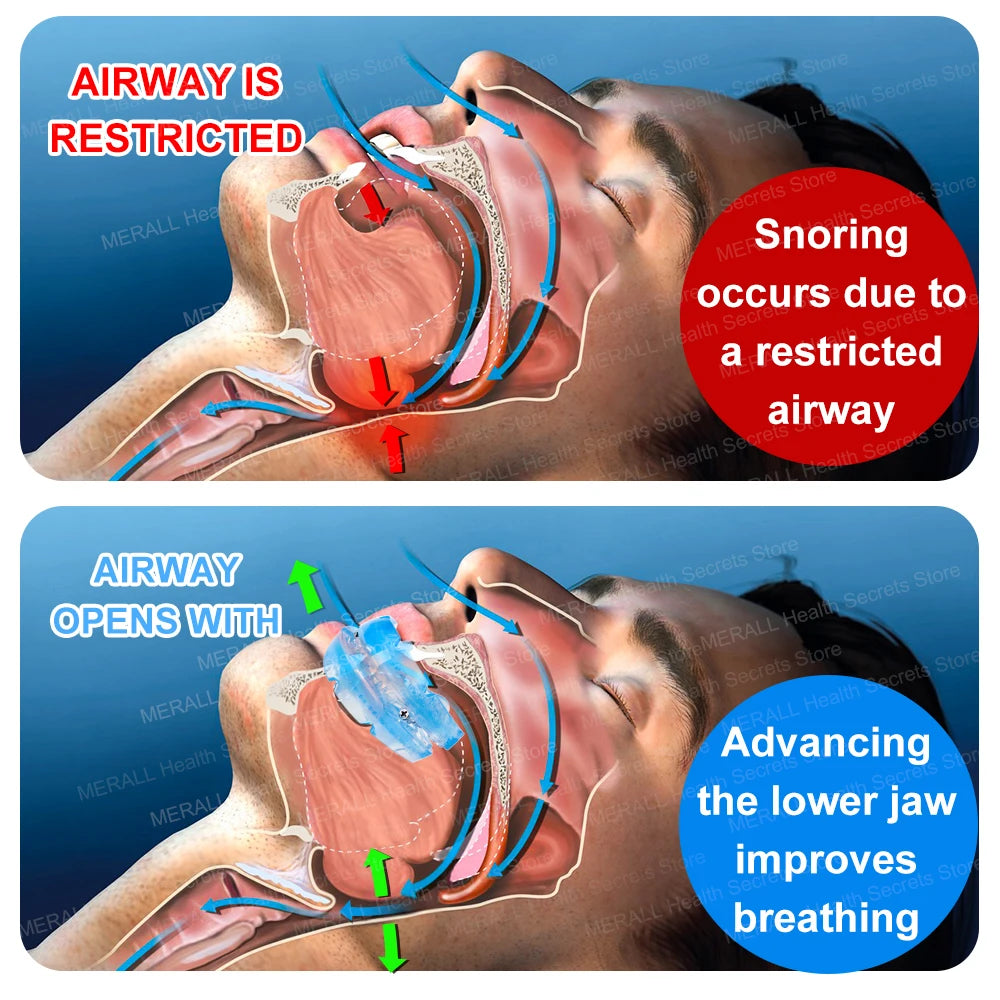 Tidesmit anti-snore bruxism mouth guard for teeth grinding and sleep apnea relief