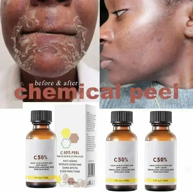 Salicylic Acid Face Peel - Professional Deep Exfoliation & Skin Refinement Scrubs Treatments Tidesmit