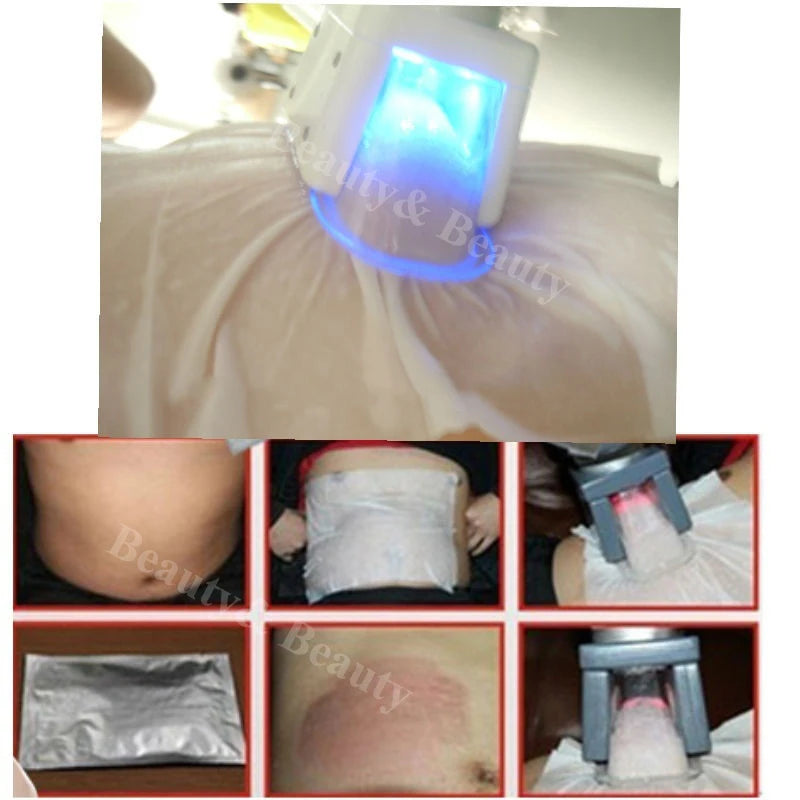 Antifreeze Membranes for Cryotherapy - 10 Pack 110g Professional Grade Scrubs Treatments Tidesmit