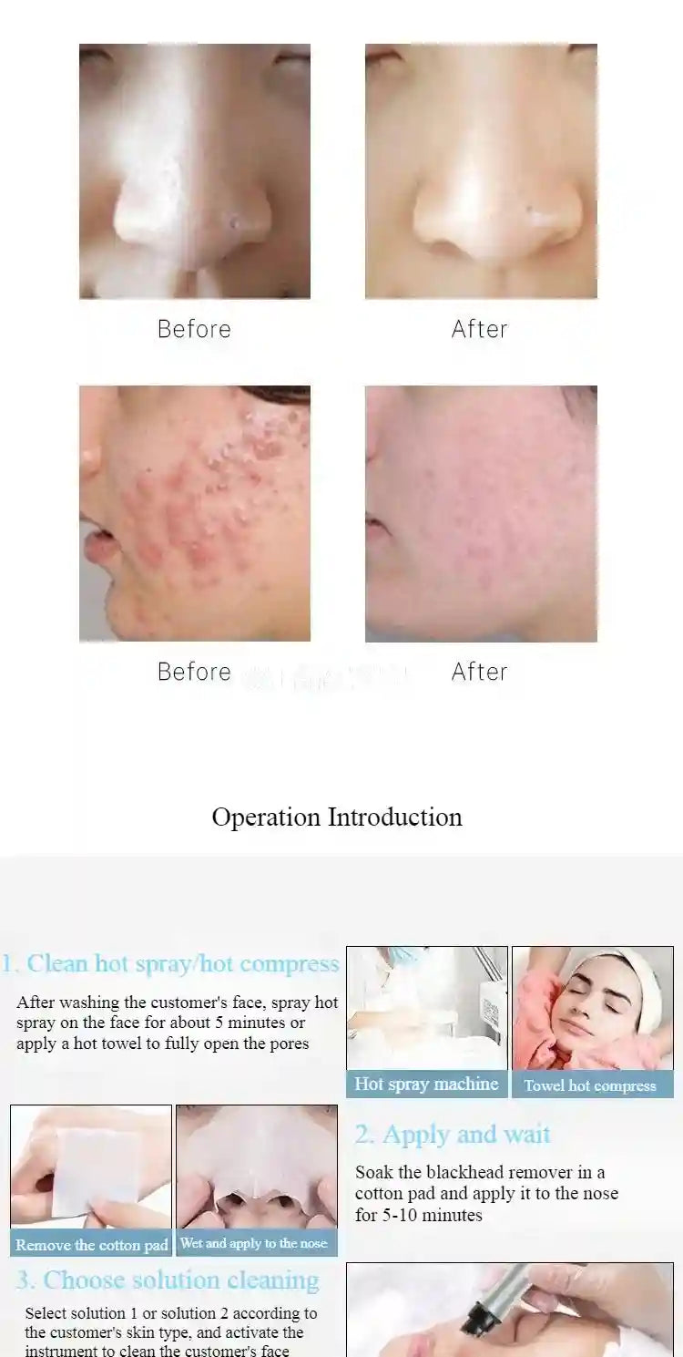 Aqua Hydra Peeling Solution 500ml - Professional Deep Pore Facial Serum Scrubs Treatments Tidesmit