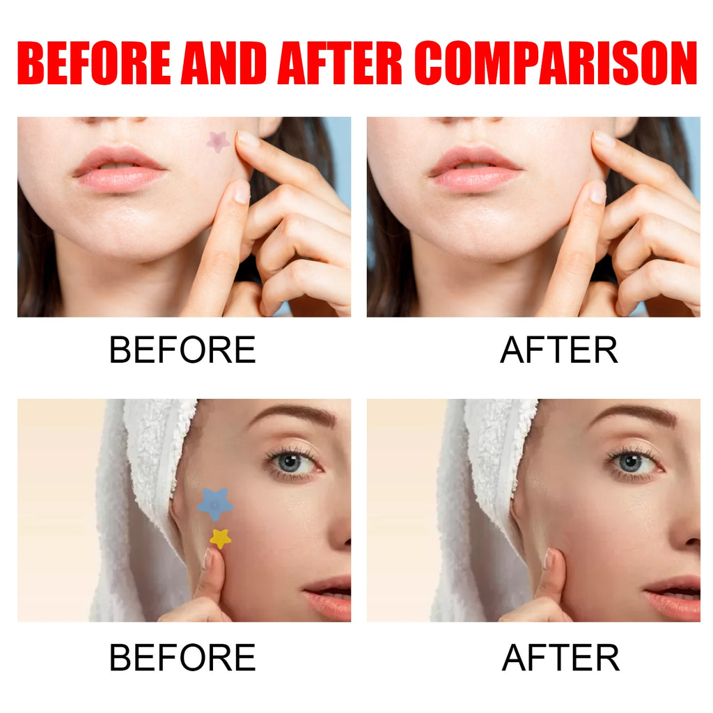 Acne Pimple Patches Sticker Repair Acne Scars Fade Blemishes Conceal Pimples Hydrocolloid Invisible Pimple Remover Tool SkinCare
