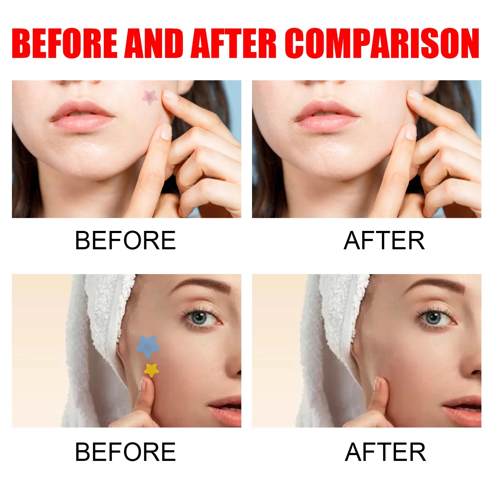 Acne Pimple Patches Sticker Repair Acne Scars Fade Blemishes Conceal Pimples Hydrocolloid Invisible Pimple Remover Tool SkinCare