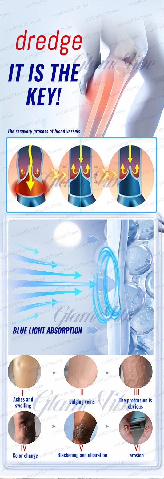 Diagram illustrating vein recovery, blue light therapy for blood vessels, and progressive stages of vein damage.