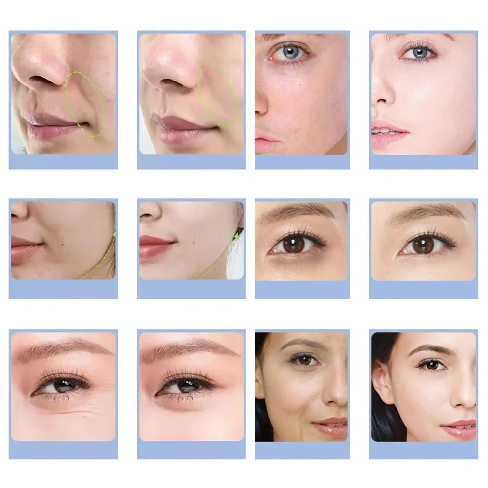Before and after results of CO2 oxygen bubble facial machine showing skin rejuvenation, exfoliation, and lifting.