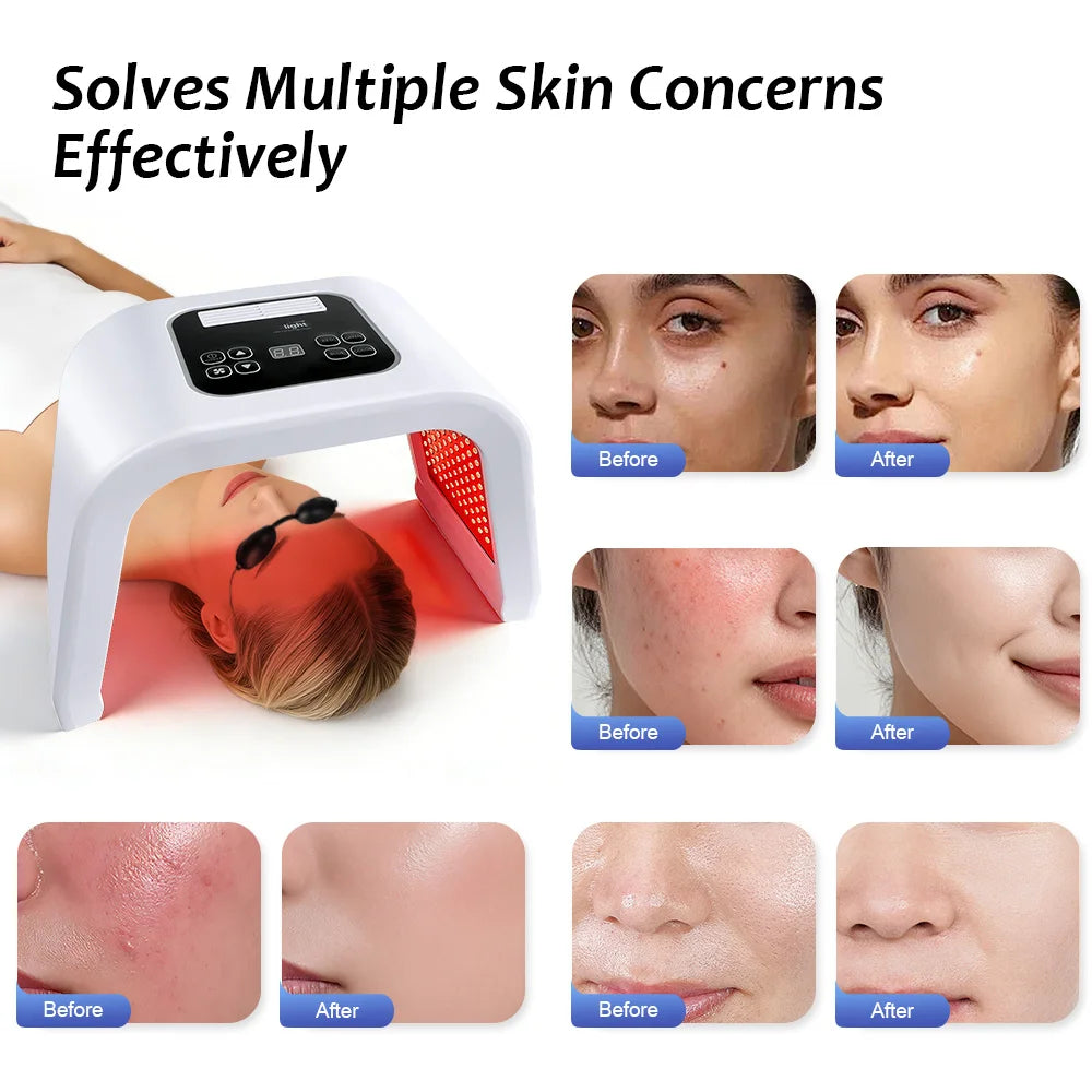 White arched 7-color LED facial therapy device over a woman’s face, with before-and-after skin improvement examples.