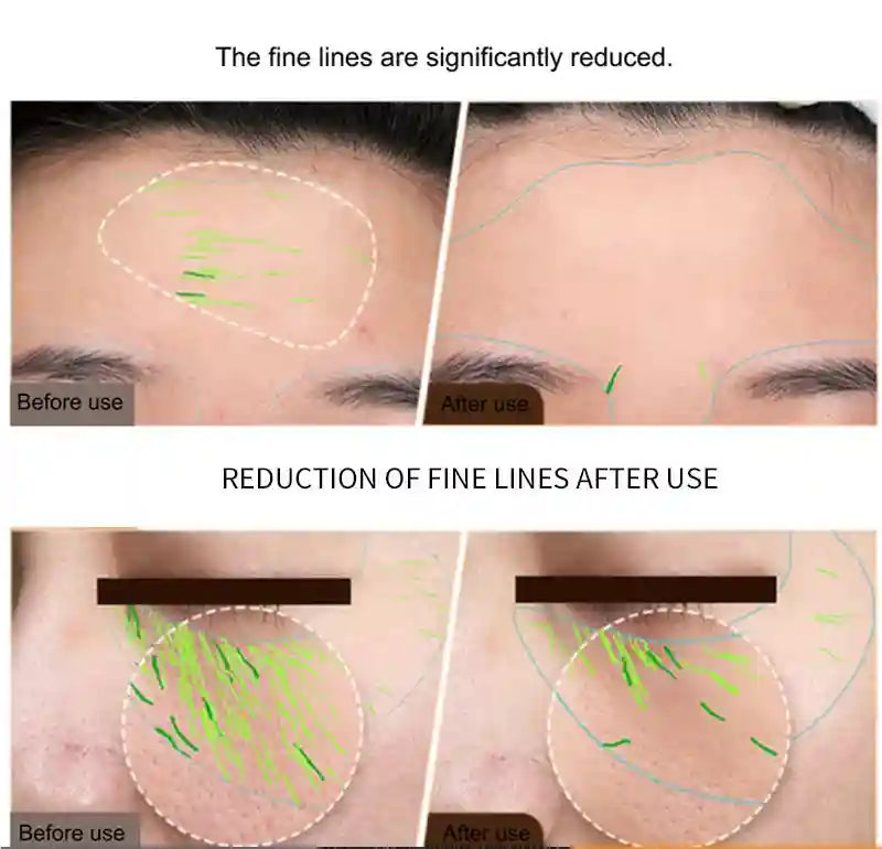 RF Radio Frequency Facial Machine for Skin Tightening - Tidesmit Eye Massage Instrument Tidesmit