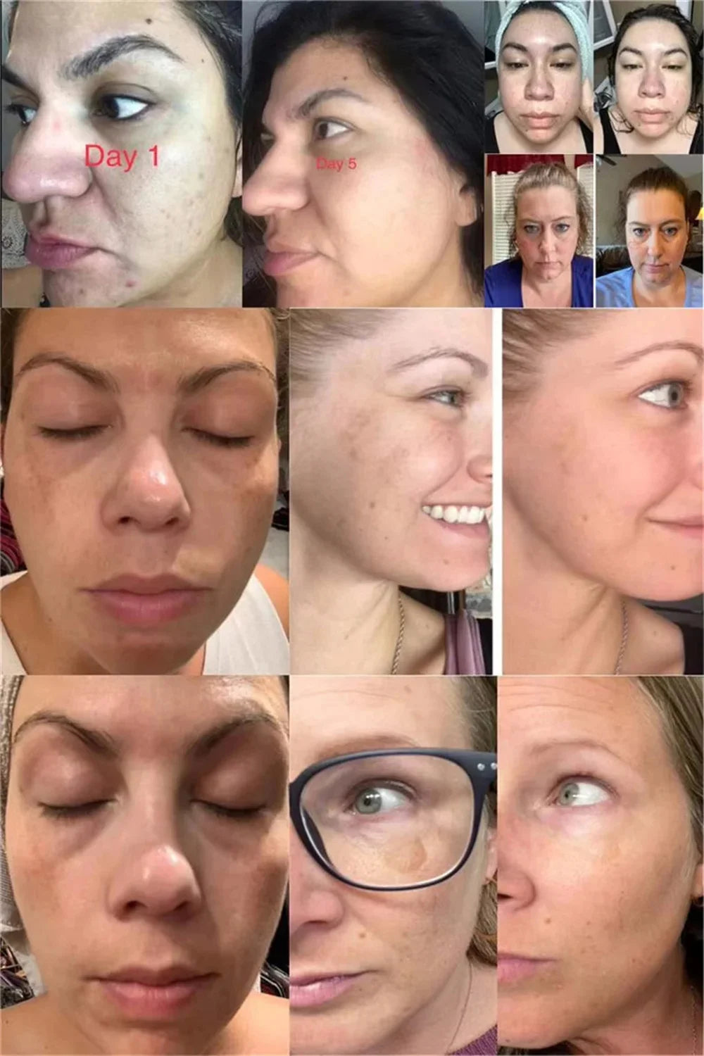 Before and after skin care progress photos showing reduced facial dark spots and hyperpigmentation across multiple