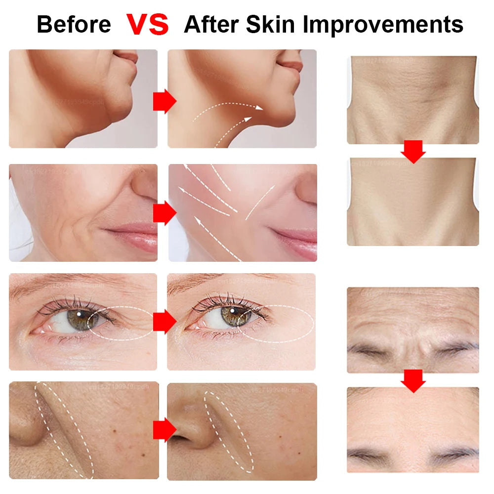 Before and after comparison of skin treatments showing reduced wrinkles and lifted skin on the face, neck, and eyes.