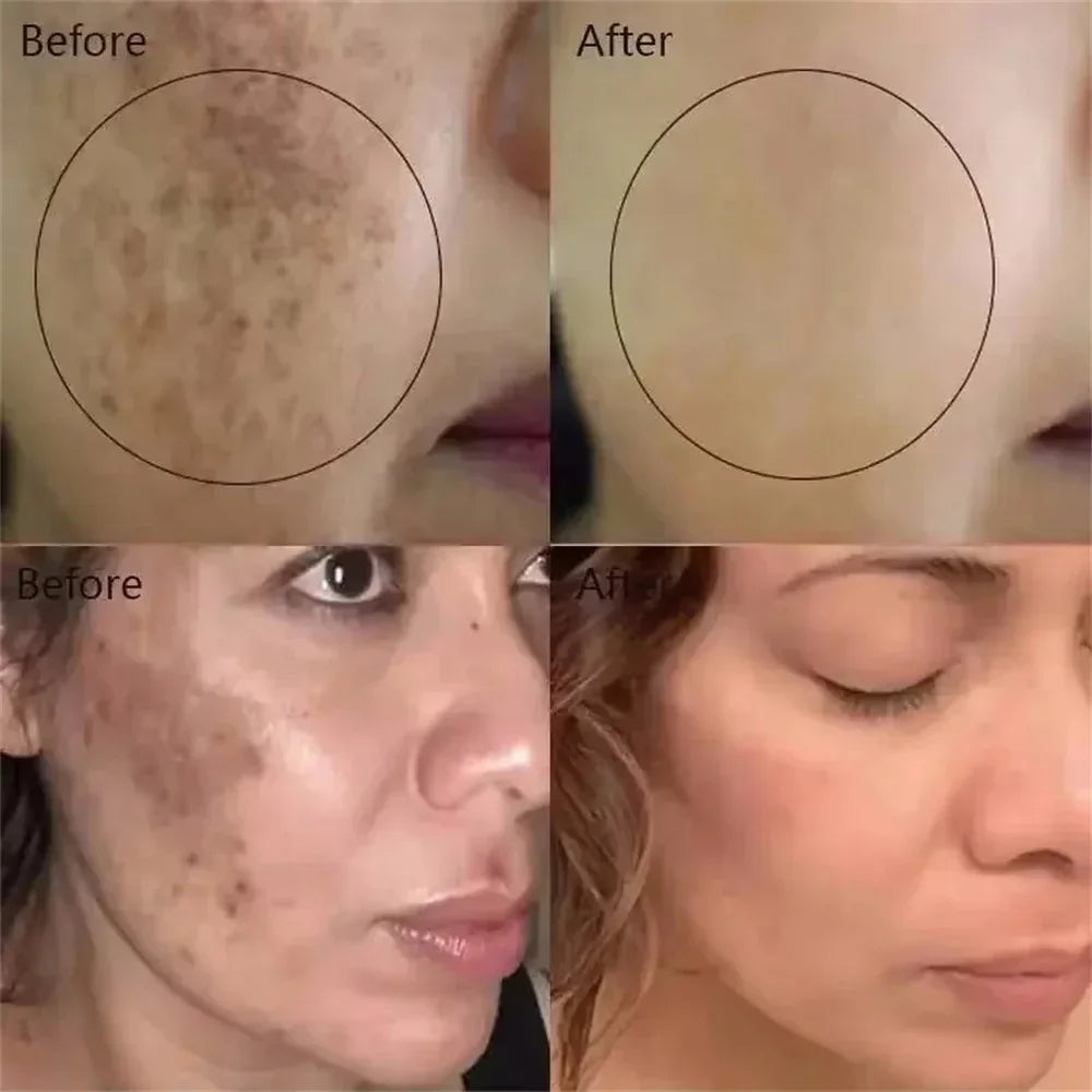 Before and after comparison of a person's face showing reduced dark spots and pigmentation from skin care treatment.