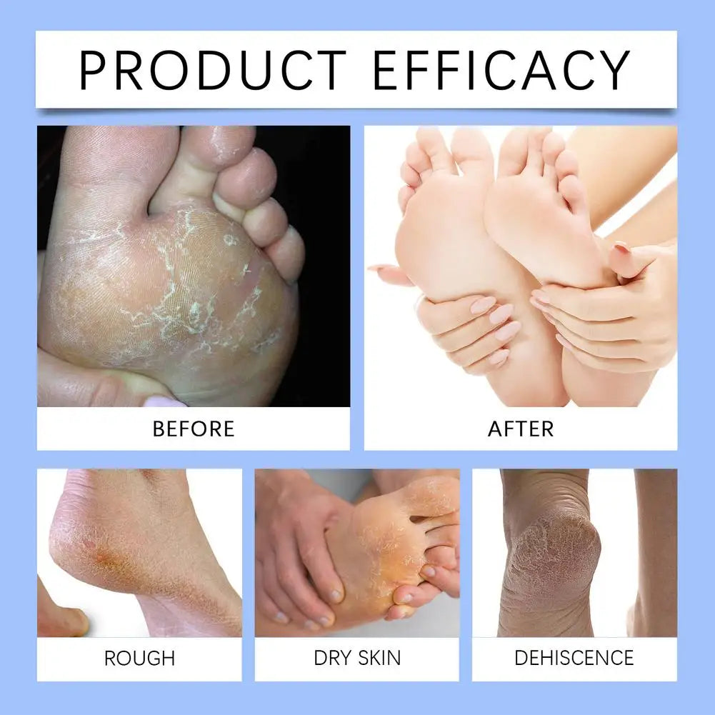 Urea 60% Cream for Cracked Heels - Professional Deep Foot Repair Scrubs Treatments Tidesmit
