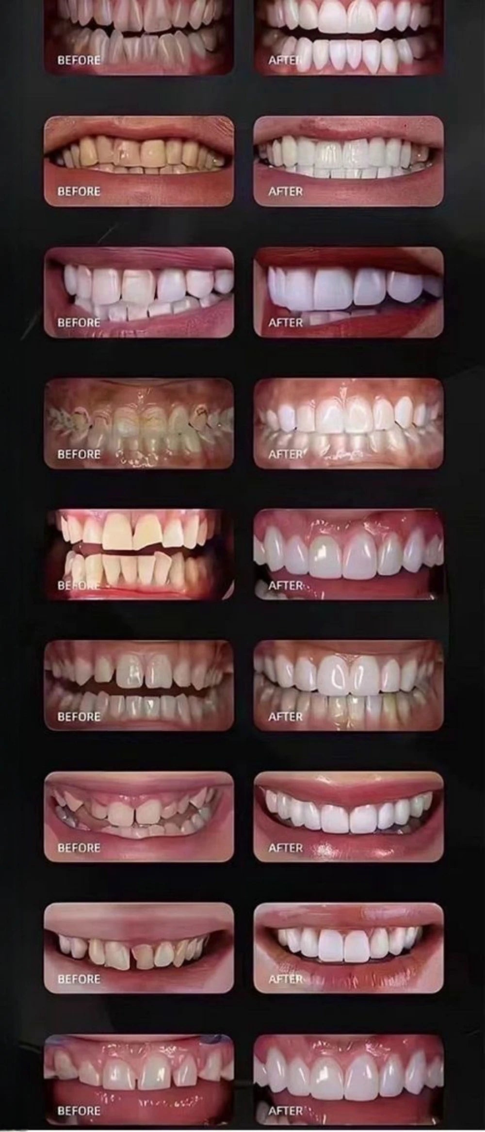 30PCS Lodden Lithium Disilicate C14 Dental Lab Glass-matrix Ceramics Block Chairside Restoration Aesthetics Materials Wholesale