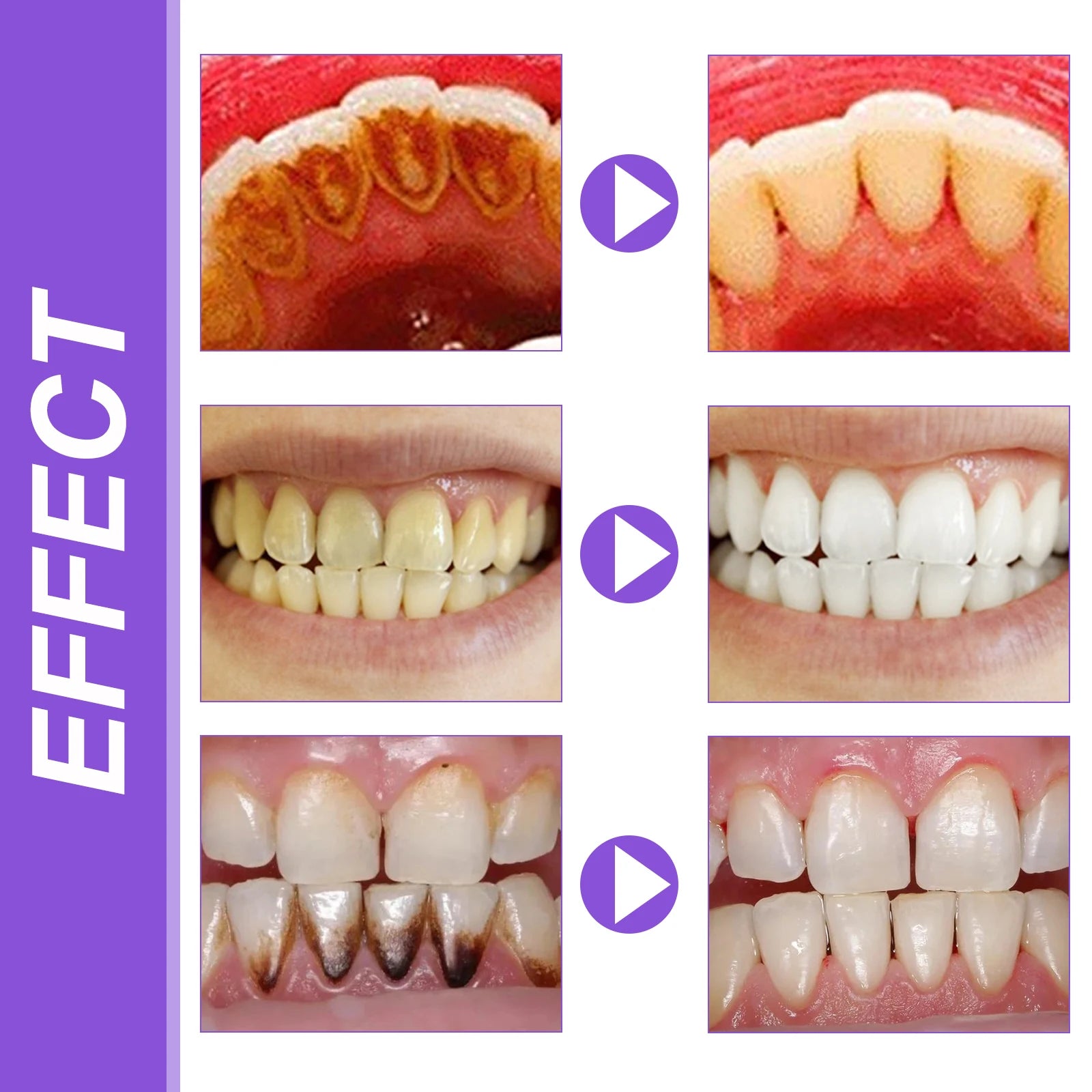 Tidesmit EELHOE Teeth Whitening Mousse with Nano-Hydroxyapatite for Bright Smile