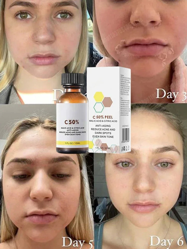 Salicylic Acid Peeling Lotion for Dark Skin | Professional Exfoliation Scrubs Treatments Tidesmit