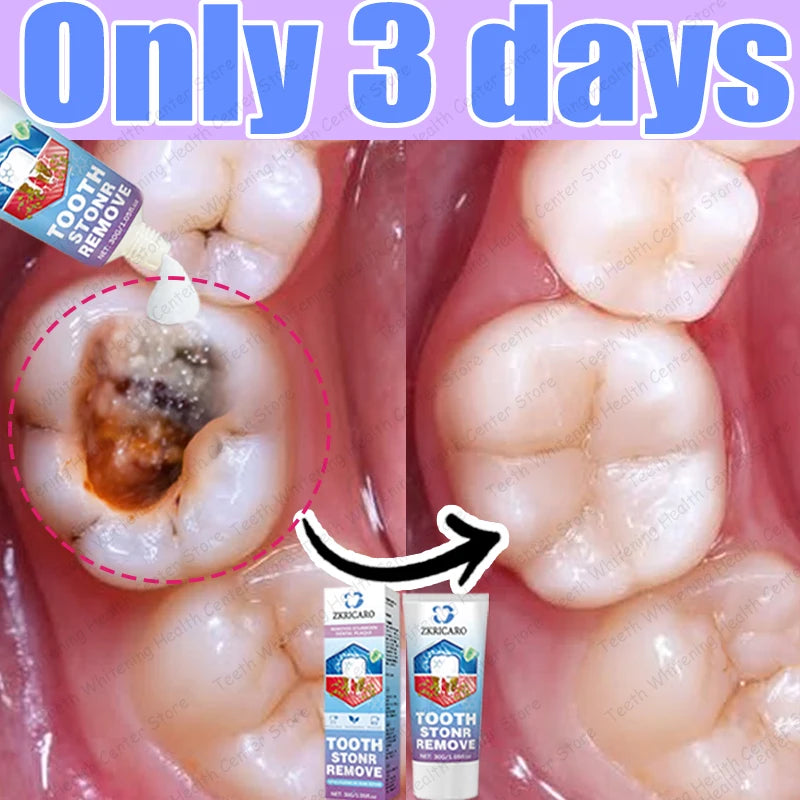 Tooth Decay Repair Treatment | Natural Deep Cleaning & Restorative Formula Scrubs Treatments Tidesmit